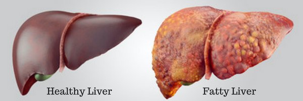 How Long Does It Take To Reverse A Fatty Liver? | Fix Your Fatty Liver